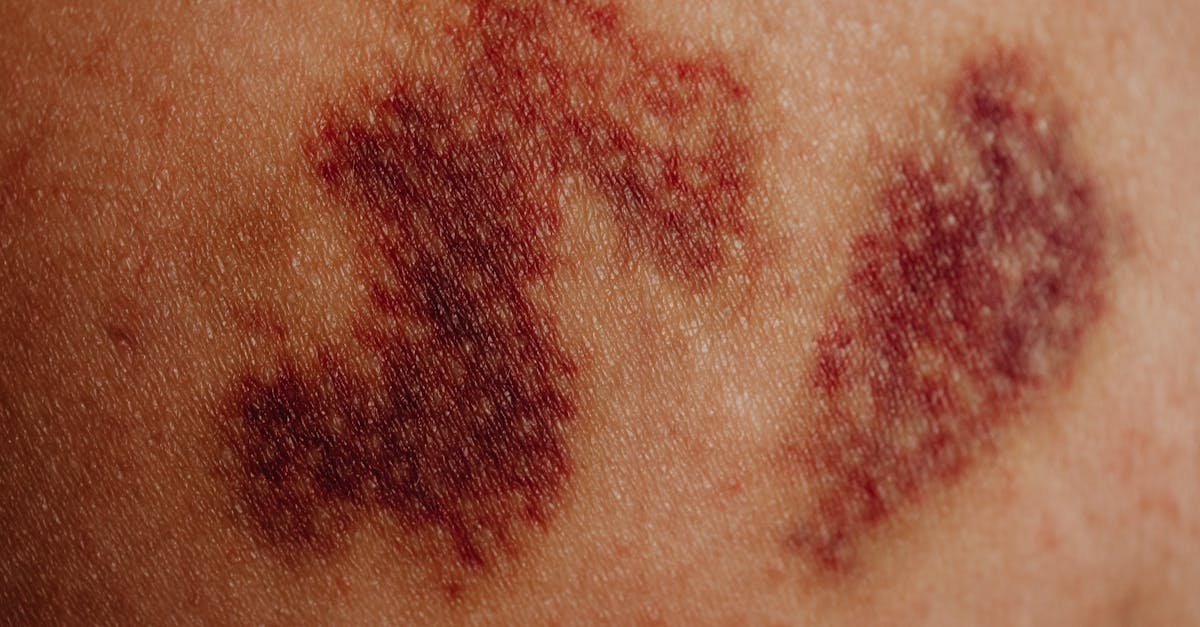 Supplements for Rosacea: Evidence-Backed Benefits and Realistic Expectations